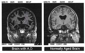 Alzheimer's_disease_-_MRI